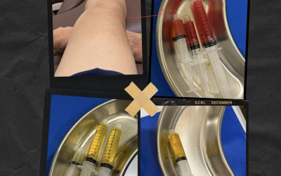 Yuk Simak, Meniscus Tear Complex yang Dialami Ariel Noah dan Kenapa Kita harus Aware dengan Masalah Lutut Ini